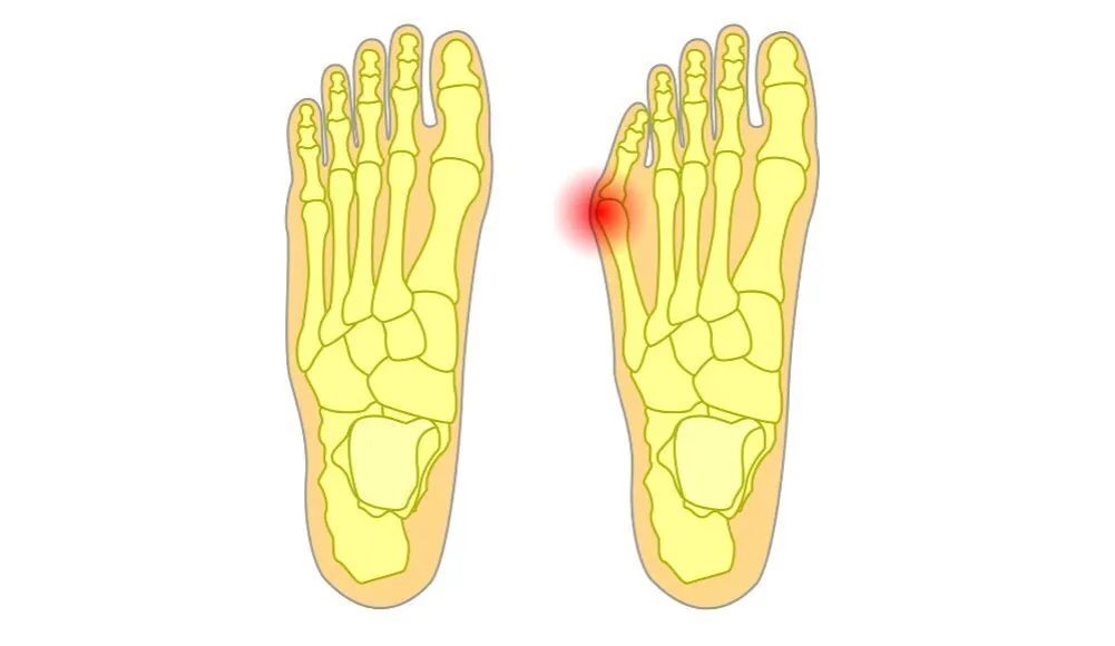 haluksy małego palca przyczyny buty genetyka