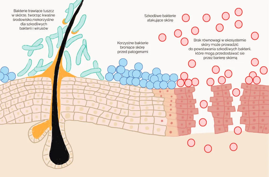 przekrój skóry z zatkanym porem i bakteriami