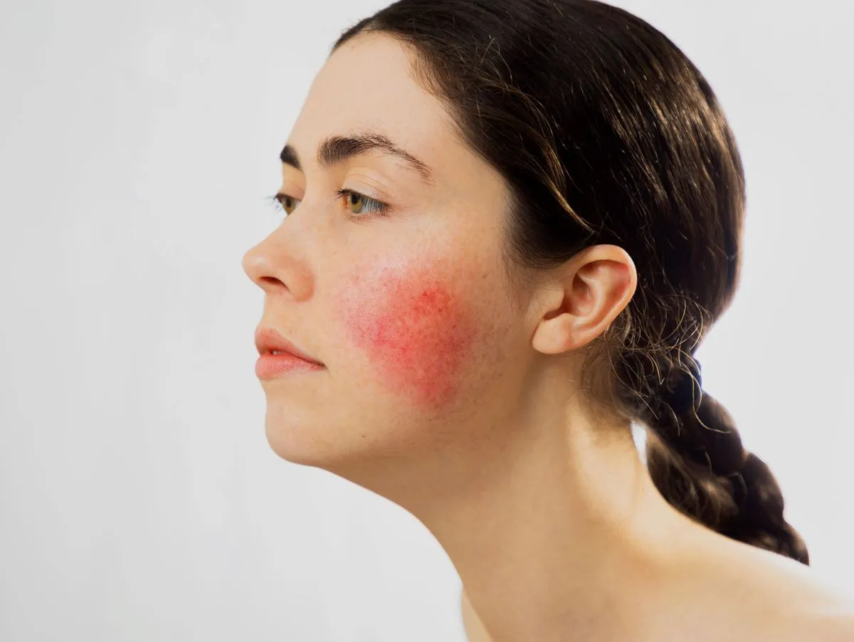 Frau mit gereizter geröteter Gesichtshaut vor dem Spiegel