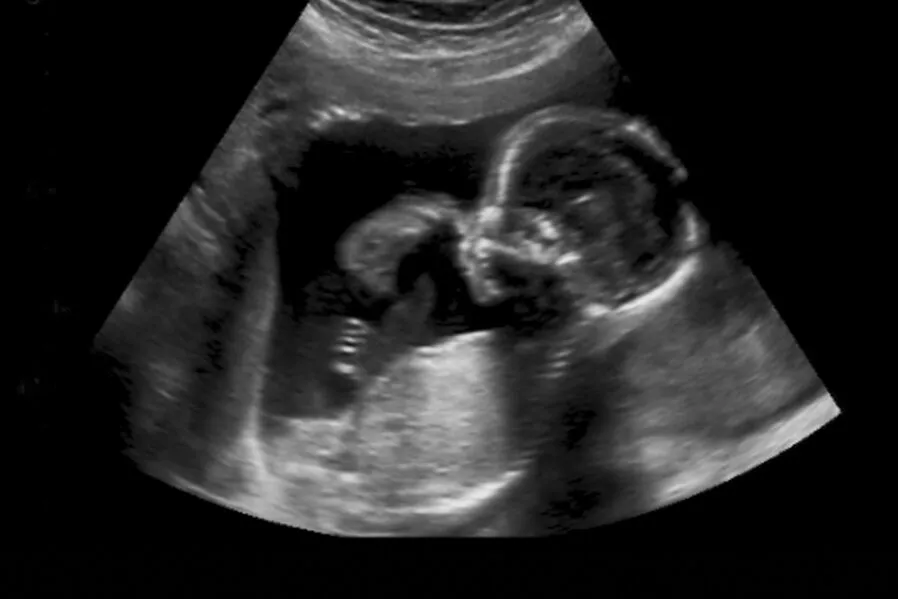 Ultraschall Schwangerschaft Baby