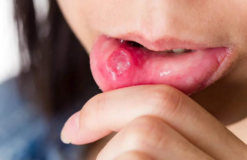 domowe sposoby na afty