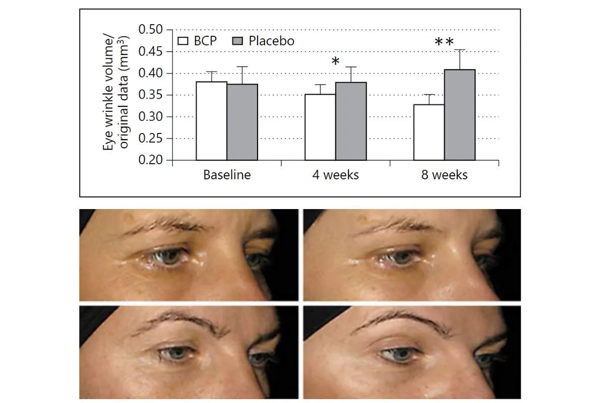 Wyniki badania kolagen przed i po: zmniejszenie objętości zmarszczek wok&oacute;ł oczu po 4 i 8 tygodniach stosowania BCP.