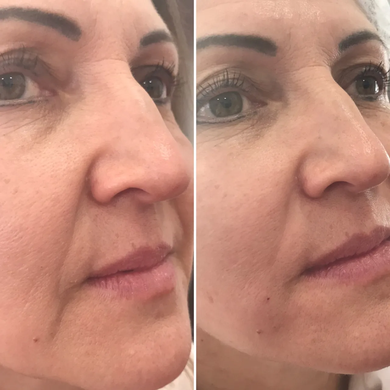 Zdjęcie Bruzdy nosowo-wargowe: Botox czy kwas hialuronowy - co wybrać?