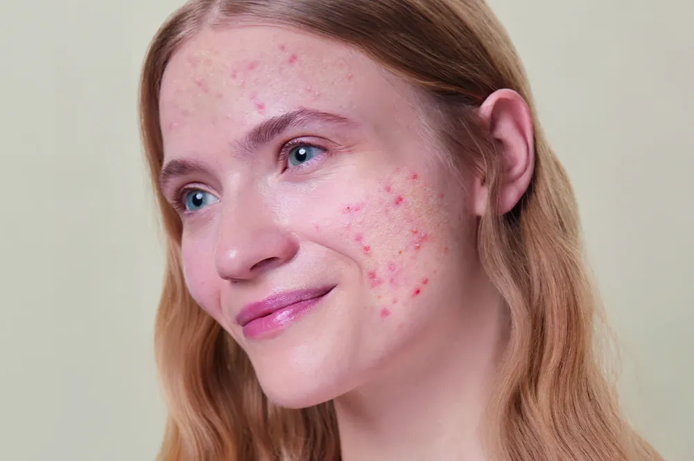 składniki aktywne na czerwone plamy po trądziku