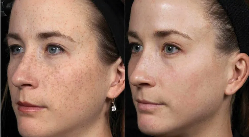 kobieta z promienną cerą, przed i po rozjaśnianiu przebarwień
