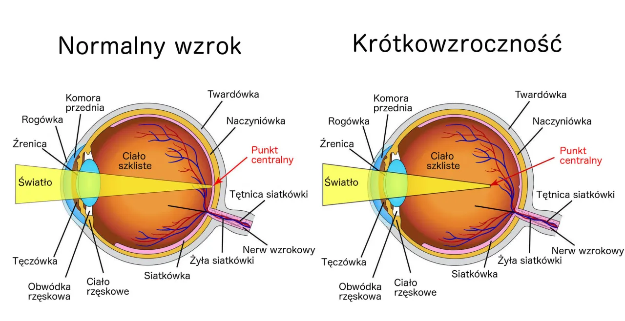 anatomia oka krótkowzroczność schemat