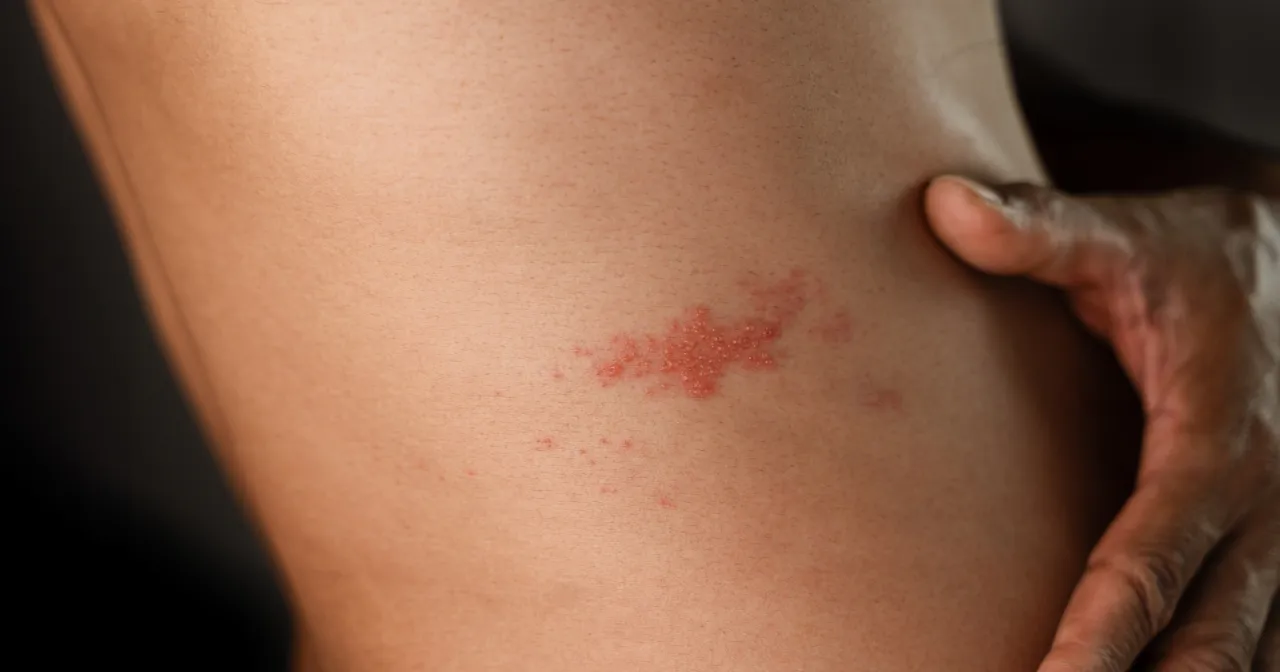 Półpasiec wysypka na skórze