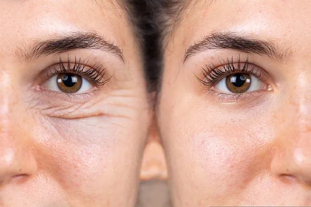 zmarszczki pod oczami rodzaje botoks