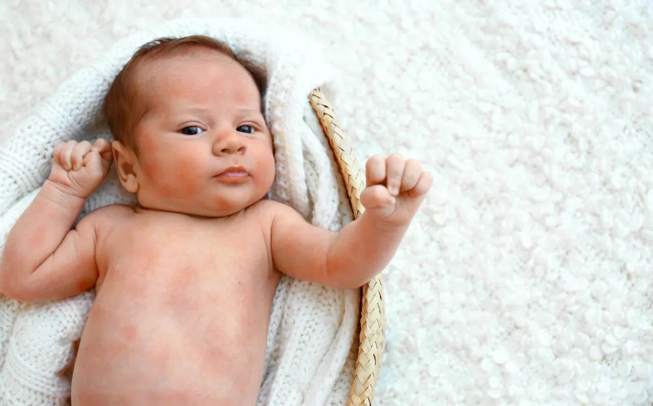 objawy uczulenia na gluten u niemowląt wysypka brzuszek