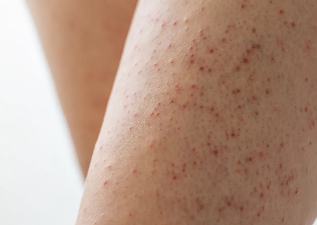 Zapalenie mieszk&oacute;w włosowych vs rogowacenie okołomieszkowe na sk&oacute;rze