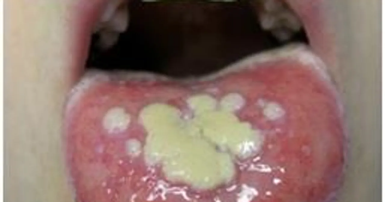 Język z licznymi, bolesnymi aftami. Warto skonsultować się z lekarzem, do jakiego specjalisty udać się z aftami.