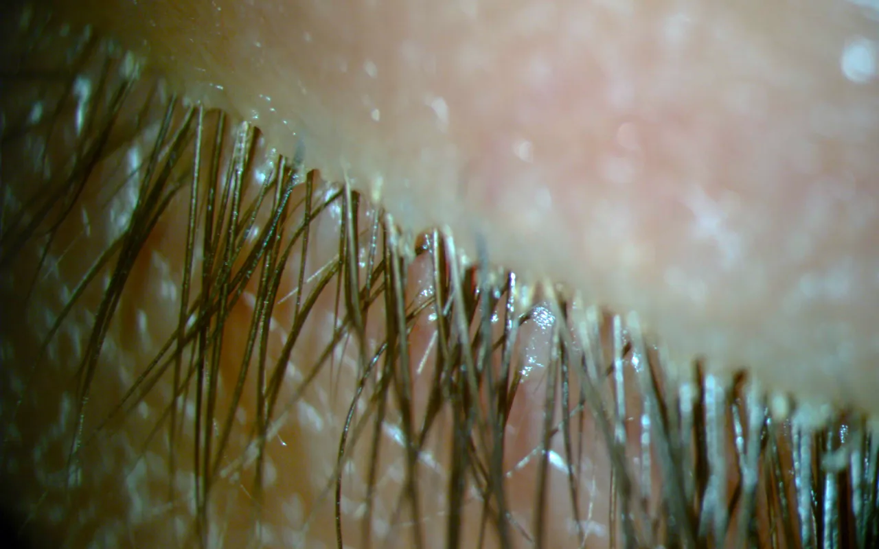 nużeniec na rzęsach objawy łupież cylindryczny