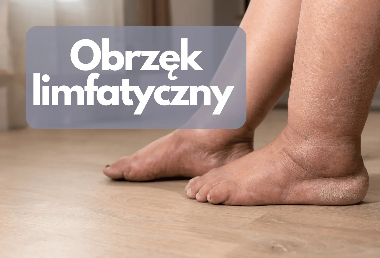 ćwiczenia na obrzęk limfatyczny n&oacute;g w leżeniu