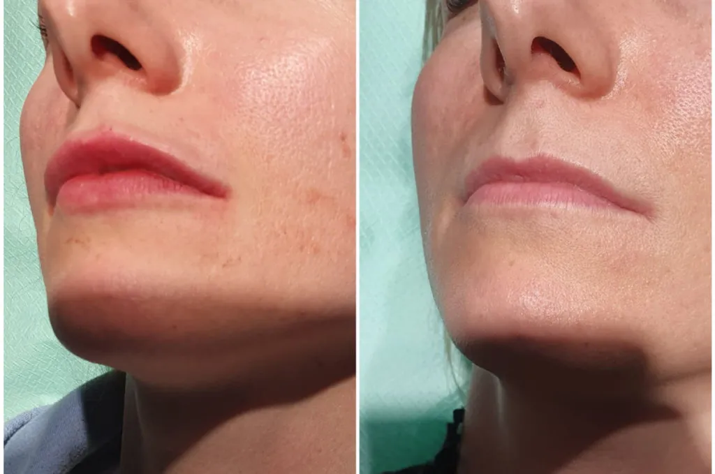Porównanie ust przed i po laserze oraz kwasie hialuronowym