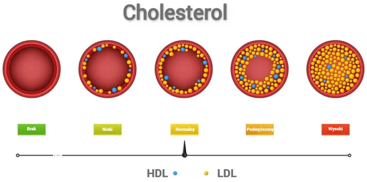Zdjęcie Jak obliczyć cholesterol LDL i uniknąć problemów zdrowotnych