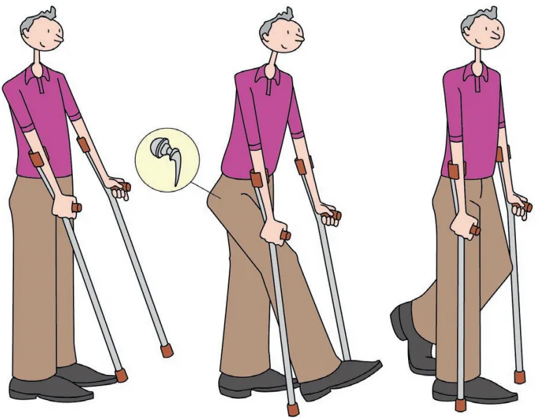 Zdjęcie Peut-on courir avec prothèse de hanche sans risque pour sa santé ?