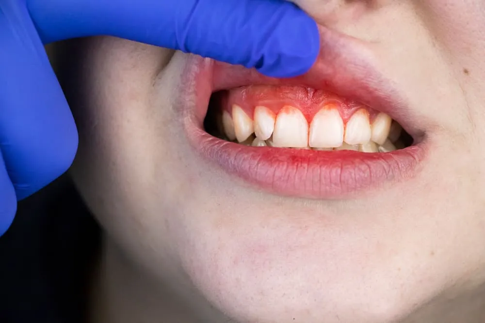Zdjęcie Co na bolące dziąsło od ósemki – skuteczne sposoby na ulgę i kiedy iść do dentysty