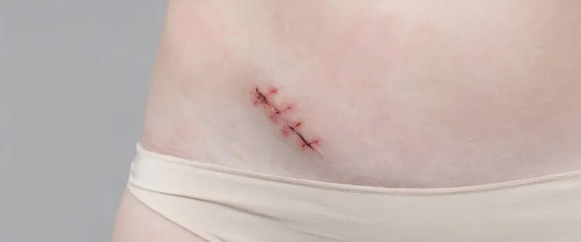 Zdjęcie Zapalenie wyrostka u dziecka - rozpoznaj objawy i uratuj malucha w porę