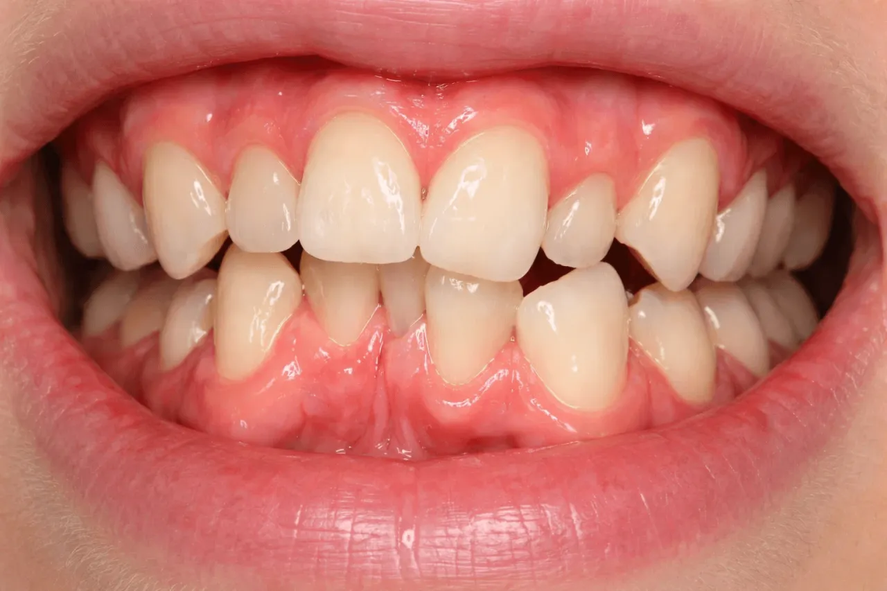 dziecko z wadą zgryzu, stłoczone zęby