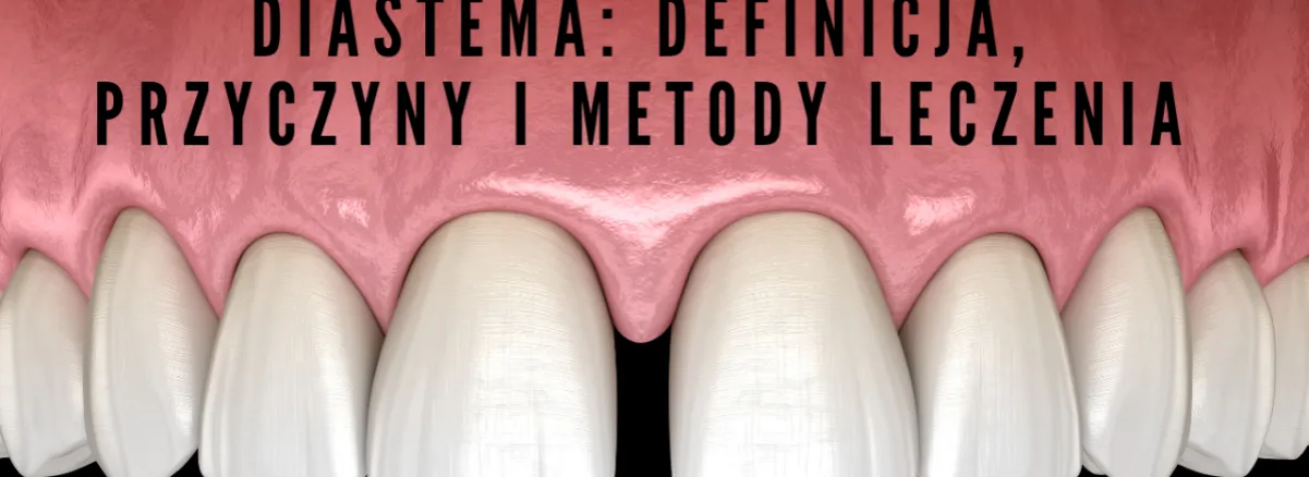 Rodzaje diastemy: równoległa, zbieżna, rozbieżna schemat