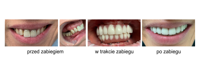 implanty zębowe przed i po