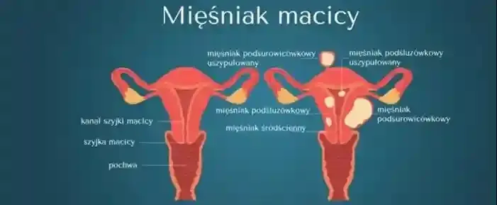 objawy mięśniaków macicy ucisk