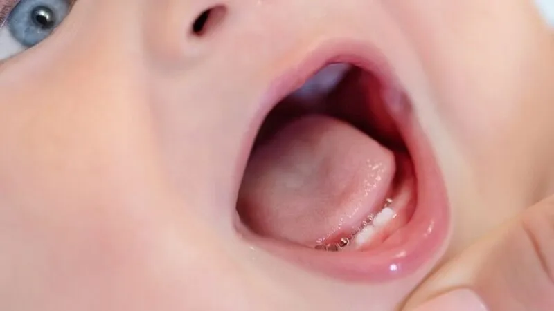 krwiak na dziąśle u niemowlaka ząbkowanie