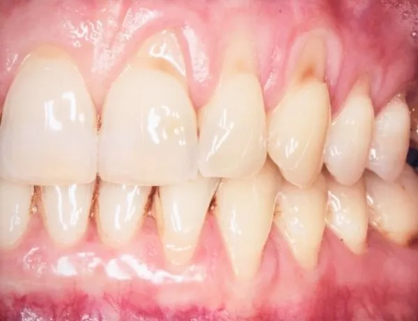 recesja dziąseł abrazja szkliwa