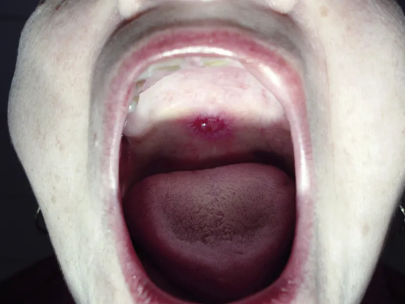 kiła pierwotna w jamie ustnej wrz&oacute;d twardy