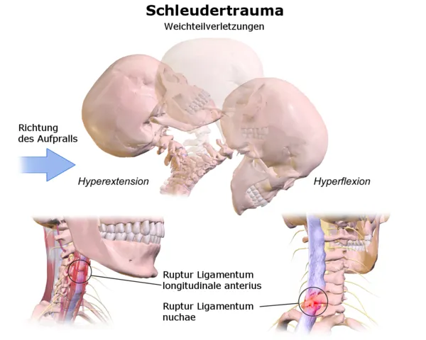 Illustration einer Halswirbelsäule mit Weichteilverletzungen nach einem Schleudertrauma