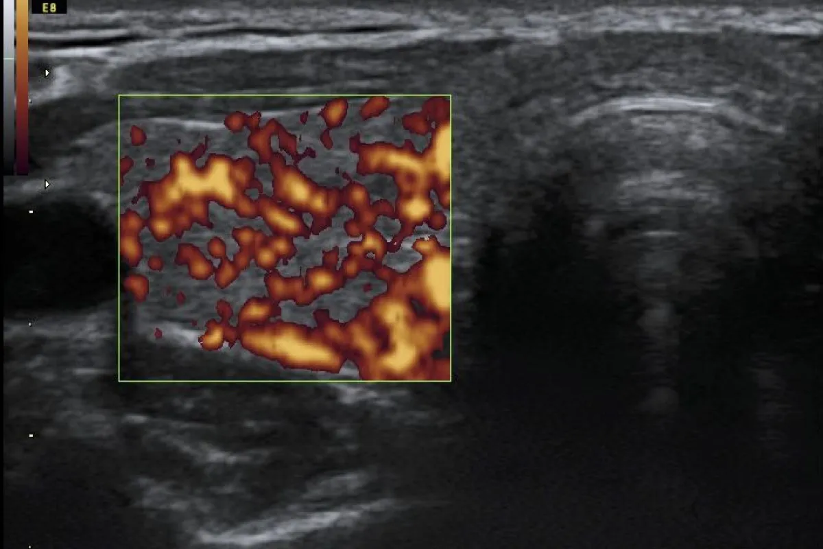 Obrzęk śluzowaty twarzy