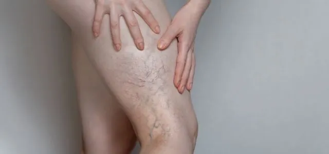 objawy zakrzepicy żył głębokich por&oacute;wnanie n&oacute;g