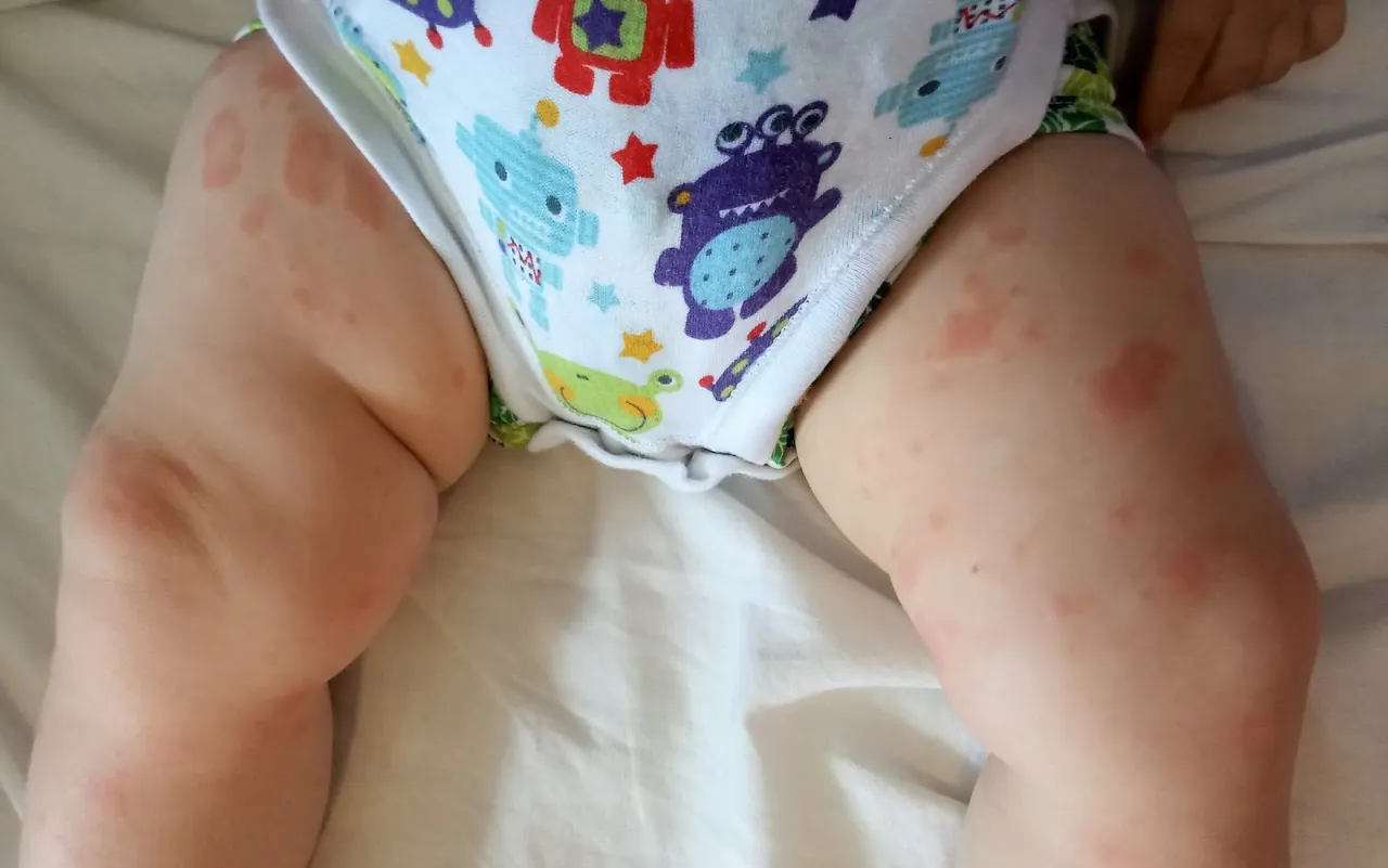 objawy alergii na białka mleka krowiego u niemowląt