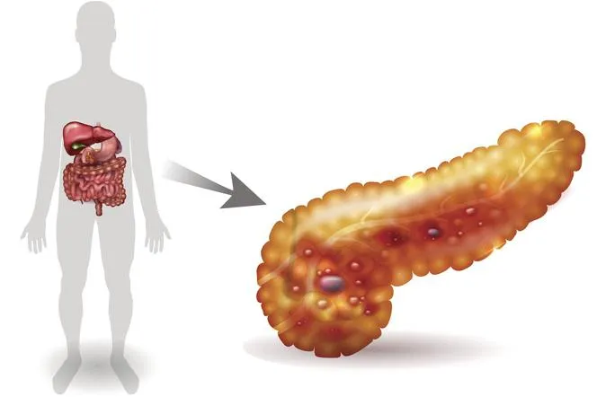 Zdrowa trzustka a trzustka z zapaleniem