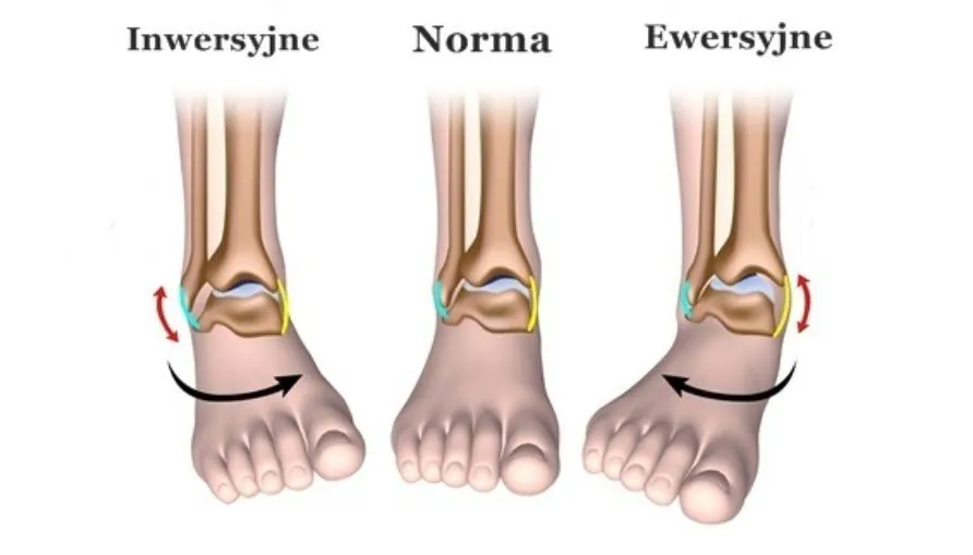 objawy skręcenia i zwichnięcia stawu porównanie