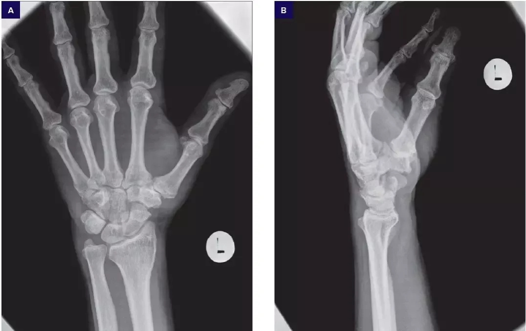 Zdjęcie rentgenowskie dłoni ze zmianami zwyrodnieniowymi