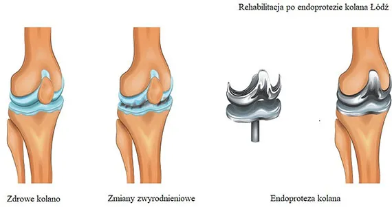 harmonogram rehabilitacji po endoprotezie kolana