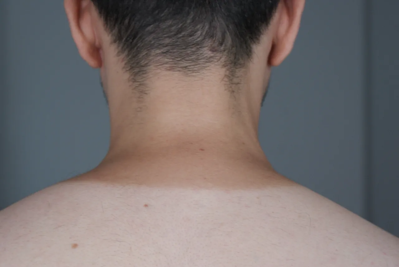 skala Fitzpatricka, fototypy skóry i włosów, Fitzpatrick scale skin hair types