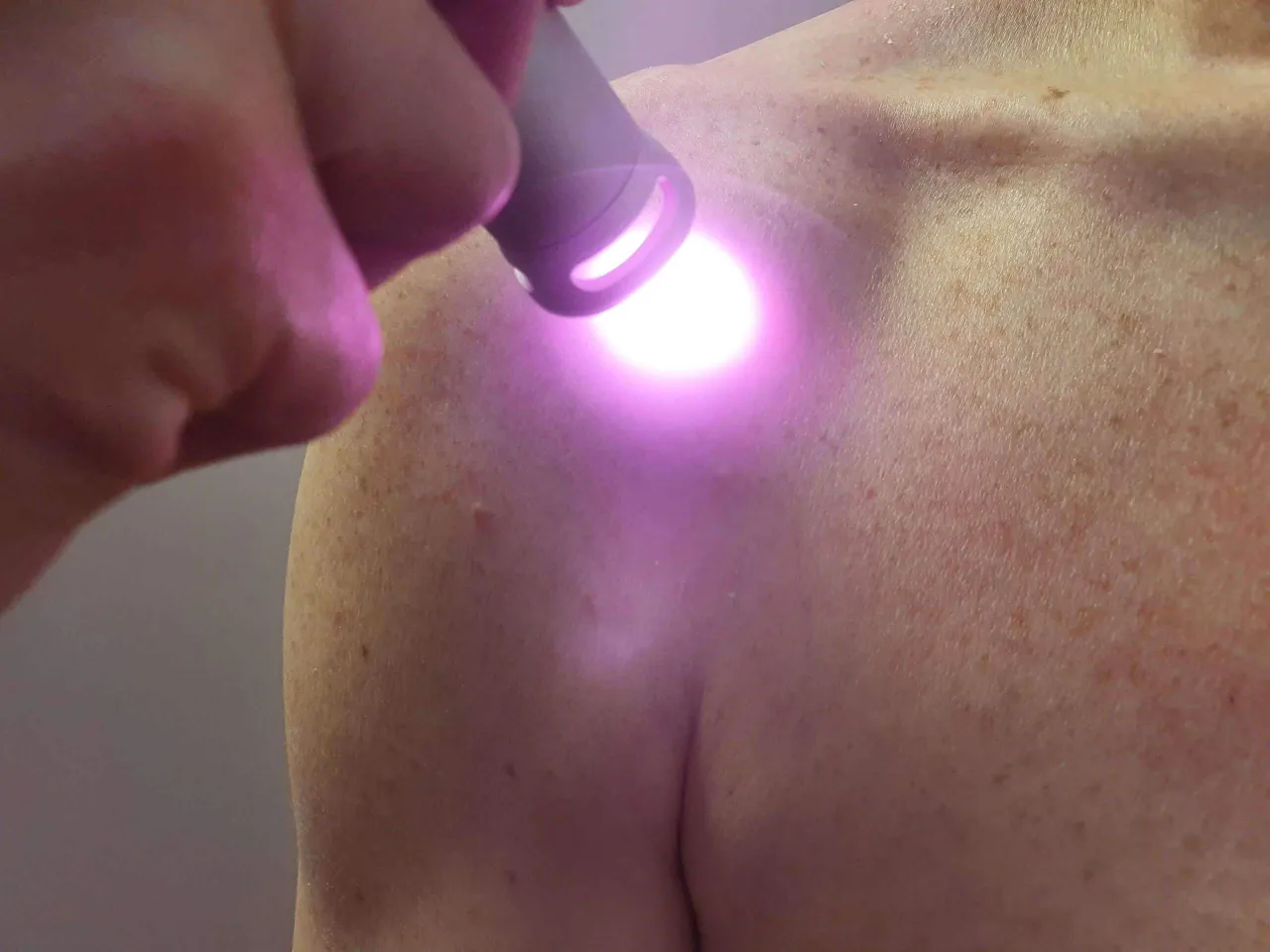 Dłoń trzyma urządzenie emitujące fioletowe światło na ramię pacjenta, pokazując, jak działa laser w rehabilitacji.