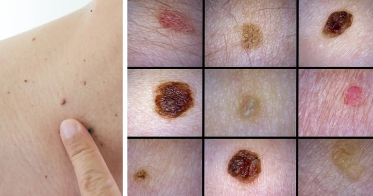 Nagły wysyp pieprzyk&oacute;w na ciele przyczyny