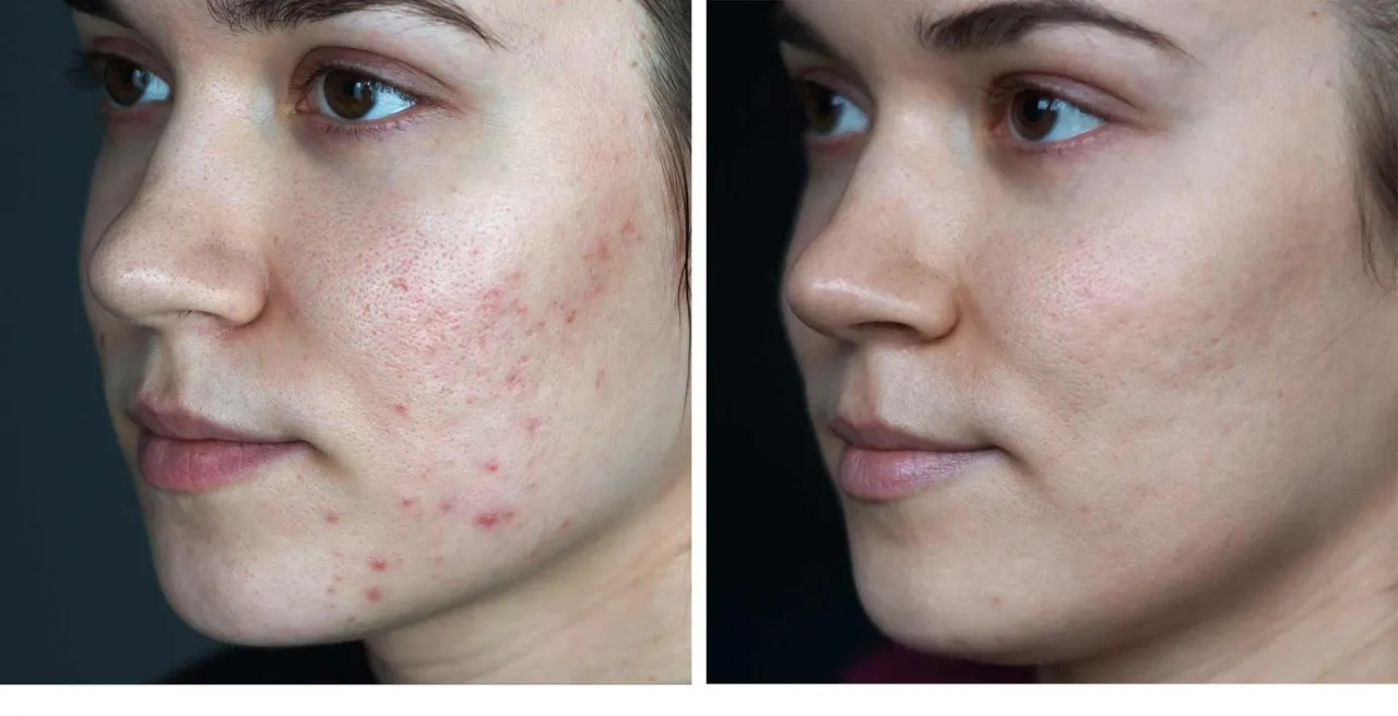 rodzaje ślad&oacute;w po pryszczach: przebarwienia i blizny