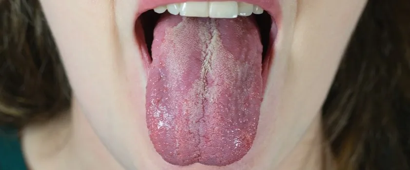 kandydoza jamy ustnej objawy język policzki podniebienie