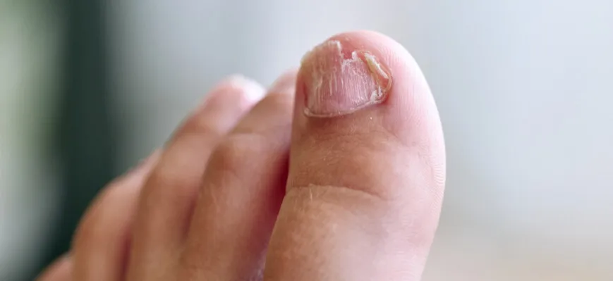 palec po utracie paznokcia wygląd łożyska