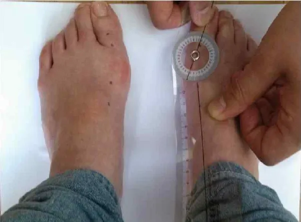 badanie stopy ortopeda haluksy