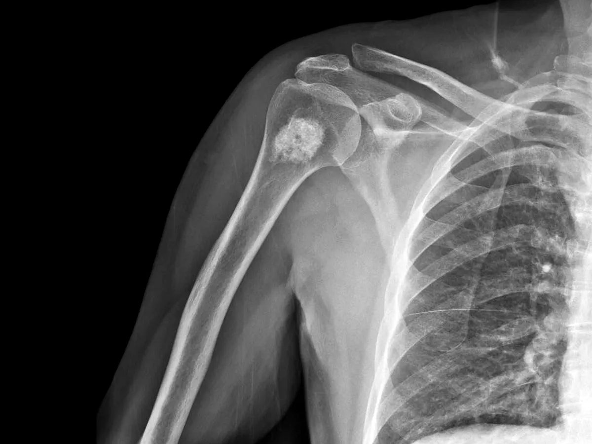 Najczęstsze nowotwory dające przerzuty do kości