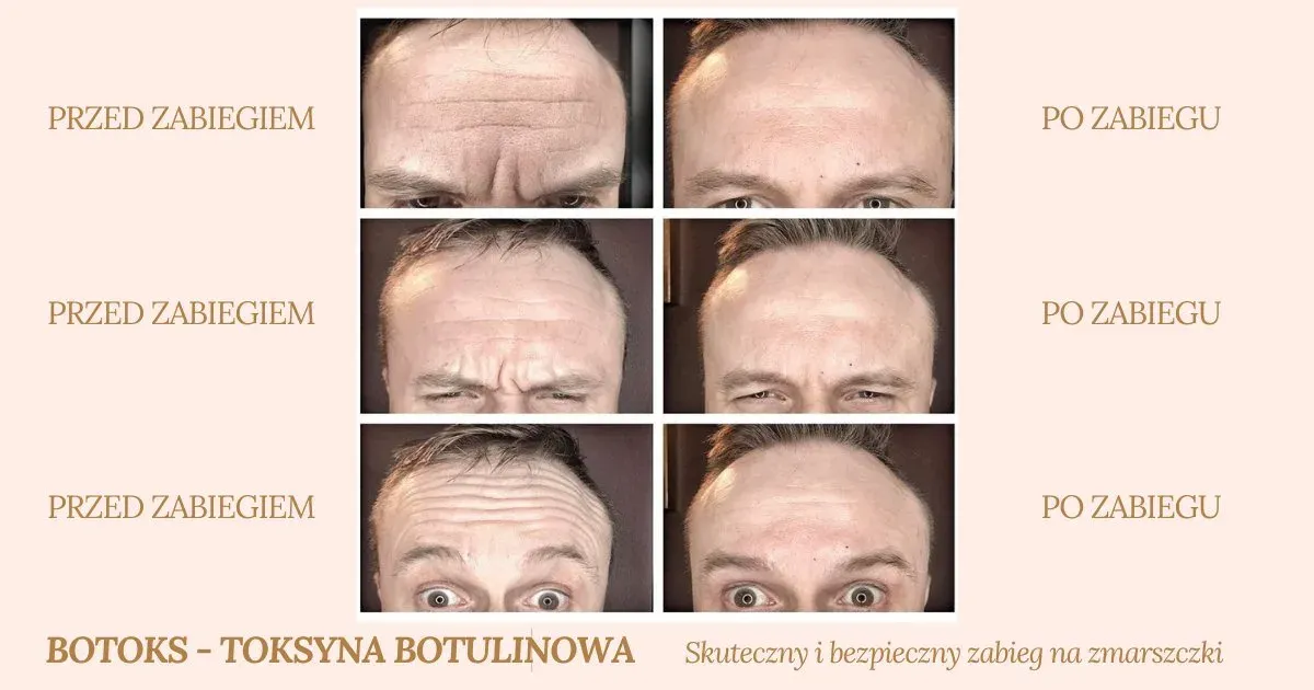 botoks efekty czasowe