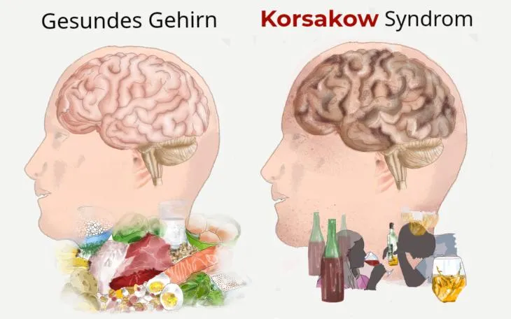 Gehirnregionen Ged&auml;chtnis Korsakow-Syndrom