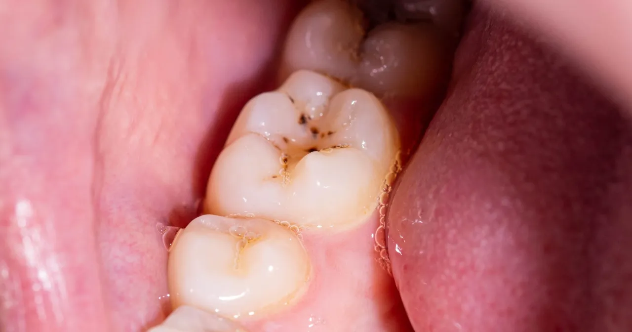 Widoczne są zęby z ciemnymi przebarwieniami i widoczną dziurą w zębie, otoczone różową tkanką i językiem.