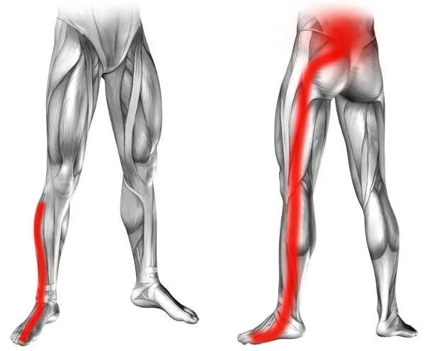 Mapa bólu rwa kulszowa i barkowa