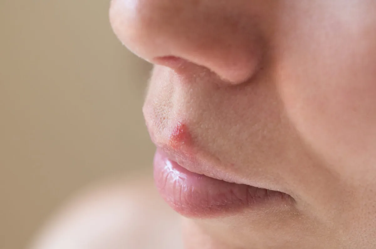 opryszczka wargowa ryzyko u dentysty